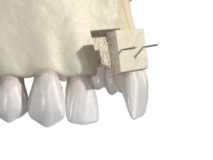 illustration showing graft of front tooth